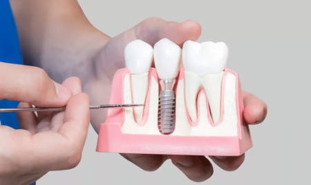 dental-implants - Athens