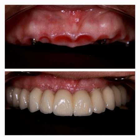 All-on-4 Dental Implants Athens