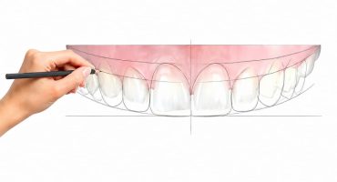 Digital Smile Design και ψηφιακός σχεδιασμός νέου χαμόγελου