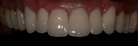 Θήκη δοντιού - Antoniou dental care